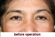 plastic-surgery-blepharoplasty